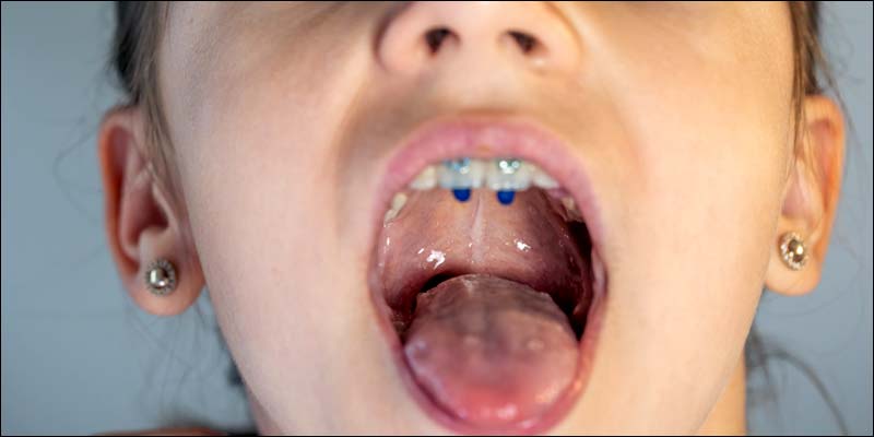 Foot and Mouth Disease Symptoms