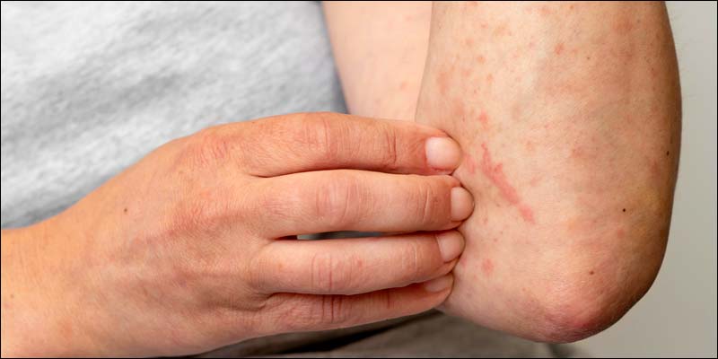 Hand Foot Mouth Disease Treatment