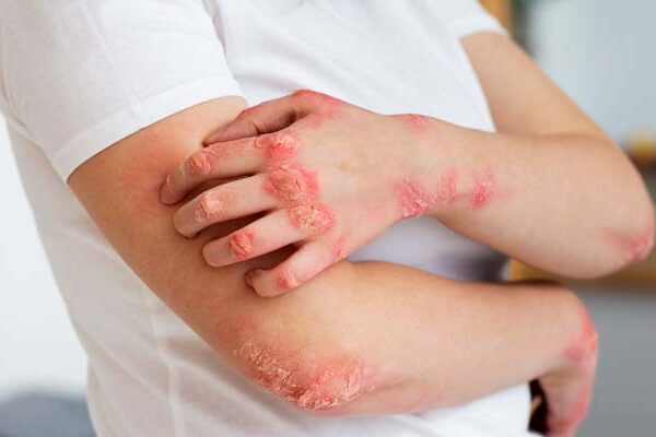 Fungal Infection on Skin
